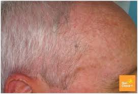 06.04.2021 · types of skin cancer less commonly seen include kaposi sarcoma, merkel cell carcinoma, specific types of tumors that start in hair follicles or skin glands, cutaneous lymphoma, and certain types of sarcomas. Skin Cancer On Scalp Skin Check Waskin Check Wa