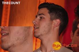 Nick Jonas Beard Attempt Bald Spots
