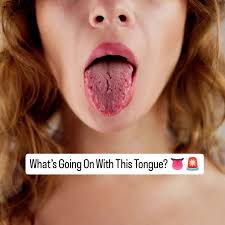 Image result for Fissured tongue