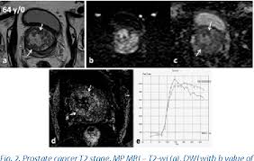 Stage 3 prostate cancer is an advanced but still treatable form of the disease. Pdf Ed It Or Ia L Use Of Multiparametric Mri In T Staging Of Prostate Cancer Semantic Scholar
