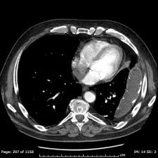 Patients with pneumonia have a poorer pleural fluid cell count and differential may give important clues as to the underlying diagnosis 10 some patients with fibrous or loculated effusions may also require intrapleural fibrinolytic therapy. Chronic Loculated Thoracic Empyema With Fade And Nonspecific Infectious Symptoms In An Elderly Patient With Diabetes Mellitus Eurorad