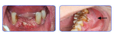 Image result for dental cancer