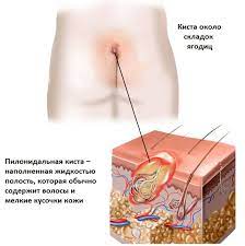 A ingrown hair is like a raised lump which feels quite hard when you push it, like a spot. Hair Has Grown And A Bump Has Formed What To Do Mechanical Removal Of Ingrown Hair At Home