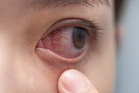 This can stimulate oil production, which can relieve red eyes by protecting tears from evaporation. Popped Blood Vessel In Eye Causes What To Do