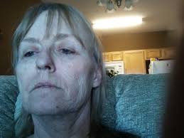 Dr Marc Salzman for Laser Resurfacing