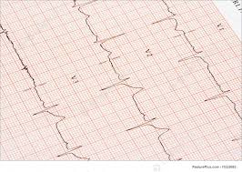 Health A Closeup Of An Ekg Printout