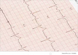 Health A Closeup Of An Ekg Printout