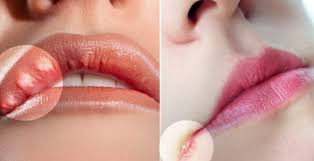 10 Cosas Que Tus Labios Dicen Acerca De Tu Salud Labios Con Hormigueo Pueden Significar Derrame Cerebral The Epoch Times En Espanol