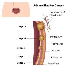 Learn about bladder cancer symptoms, treatment options, staging, risk factors and more. Bladder Cancer Symptoms And Causes Styles At Life