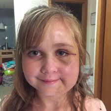 Lucy's Champions For Hope fighting Parry Romberg Syndrome added a new...