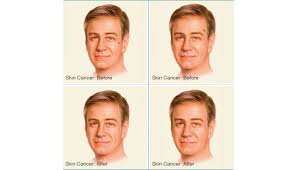 Reconstructive plastic surgery after skin cancer is a delicate and specialized type of surgery, and it is important to ask a lot of questions and pay close attention to what your doctor. Reconstructive Procedures After Skin Cancer Brigham And Women S Hospital