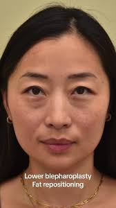 Before and after scarless lower blepharoplasty with fat repositioning. A  natural and beautiful transformation for this young woman. #plasticsurgery  #cosmeticsurgery #blepharoplasty #undereyebags ...