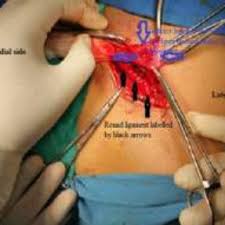 Inguinal canal transmits spermatic cord. Pdf Inguinal Hernia In Females Do We Know Enough
