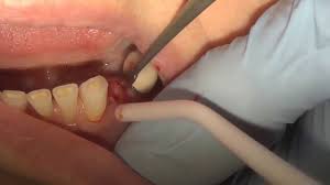 Maybe you would like to learn more about one of these? How To Pull A Broken Tooth Youtube