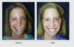 Symptoms of bell's palsy tend to come on suddenly and reach peak severity within 48 to 72 hours. Is Bell S Palsy Treatment Covered By Insurance