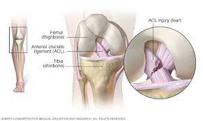 In this article, we will go deep into the functionality of acls, and. Acl Injury Symptoms And Causes Mayo Clinic