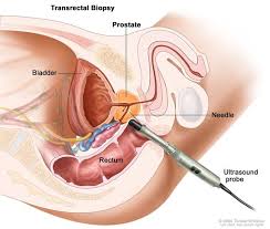 How to prepare for a cervical biopsy schedule your cervical biopsy for the week after your period. Definition Of Transrectal Biopsy Nci Dictionary Of Cancer Terms National Cancer Institute