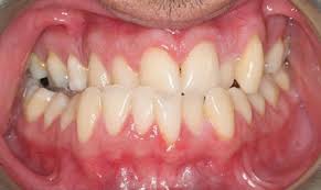 This system has the benefit of being almost unnoticeable, with the added convenience of being able to remove the aligners for up to two hours a day. Crossbite Correction About Effect Treatment Ismile Specialists