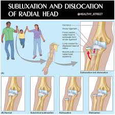 Image result for Radial Head Dislocation