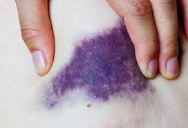 Pictures Of Bruises What The Black And Blue Is Telling You
