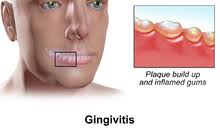 From the american heritage® dictionary of the english language, 5th edition. Gingivitis Wikipedia