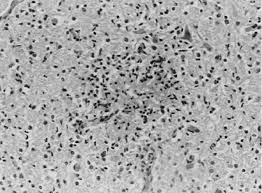 La encefalitis es una enfermedad poco común. Microfotografia De Un Foco De Encefalitis Necrotizante No Supurativa En Download Scientific Diagram