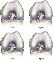 Acls are used to filter traffic based on the set of rules defined for the incoming or outgoing of the network. Original Anterior Cruciate Ligament Tear Type Classification Of Sherman Download Scientific Diagram