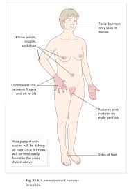 Image result for scabies on genitals
