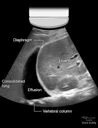 The bts guidelines state that aspiration should not be performed for bilateral effusions in a clinical setting strongly suggestive of a transudate unless there are atypical. Covid 19 Lung Ultrasound Guidance From Block Buddy