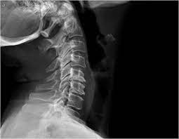 Maybe you would like to learn more about one of these? Cervical Disc Herniation Los Angeles Herniated Disc Surgery Dr Kropf