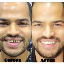 Before After Results