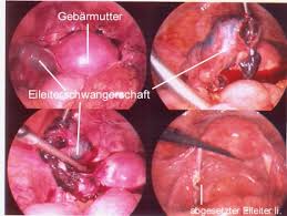 Startseiteschwangerschaftschwanger seinerste anzeichenwann merkt man, ob man schwanger ist? Eileiterschwangerschaft Ursache Diagnose Und Behandlung