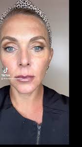 Everyone is always asking what areas can be treated with Botox! Here are a  few that prevent and treat fine lines. Also botox can give a lifting effect  by relaxing the muscles that pull the face down. ...