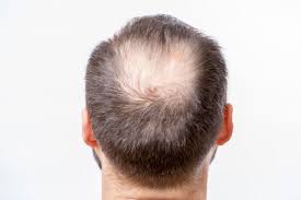 Sur quelles coiffures et coupes miser quand on a les cheveux clairsemés? Alopecie Calvitie Pelade 10 Mythes Et Realites Sur La Perte De Cheveux Huffpost Quebec Vivre