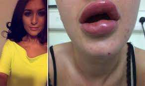 Buy lip balm online and view local walgreens inventory. Can I Put Lip Balm On After Lip Fillers Cause And Effect Of Lip Filler At Home Diy Lip Injection