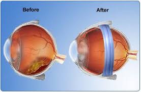 Scleral Buckle Surgery For Retinal Detachment Retina Surgery Surgery Eye Health