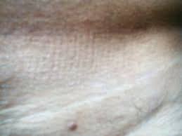 Image result for genital warts