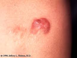 Image result for Dermatofibrosarcoma Protuberans