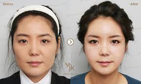Jk Plastic Surgery In South Korea Korean Plastic Surgery Best Plastic Surgery In Korea Extreme Plastic Surgery In Korea Best Plastic Surgery Clinic In Korea Kor