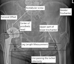 Image result for Functional Leg Length Discrepancy