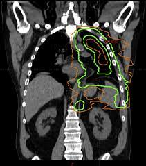 Malignant mesothelioma treatment may include surgery, radiation therapy, and chemotherapy. Radiation Therapy For Malignant Pleural Mesothelioma Thoracic Surgery Clinics