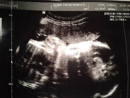 Aktifkan Hidup Anda Scan Baby Untuk Kali Kedua