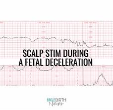 Image result for Late Deceleration