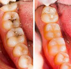 A larger filling or multiple fillings can take longer. Dental Filling And Tooth Cavity Filling Cost Treatment Causes