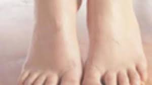 مشاكل القدم الثآليل الفيروسية البوابة
