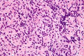 Mutational landscape of grey zone lymphoma. Primary Mediastinal B Cell Lymphoma Wikipedia