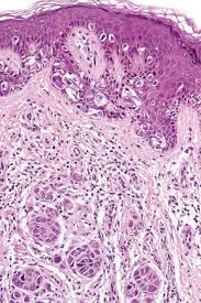 Melanoma Basicmedical Key