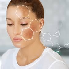Image result for Melasma