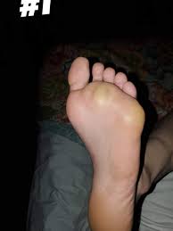 What could be causing the protrusion