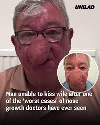 Man's Rare Nose Condition Left Him Unable to Kiss His Wife